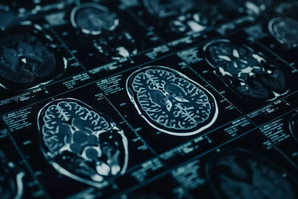 Understanding Arnold Chiari Malformation