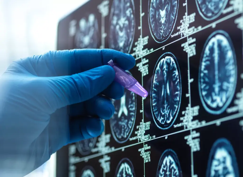 Understanding Atrial Fibrillation