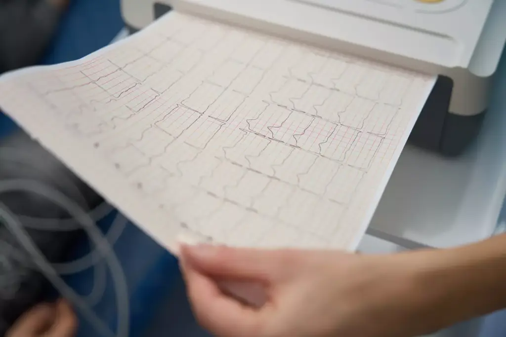 Understanding Atrial Fibrillation
