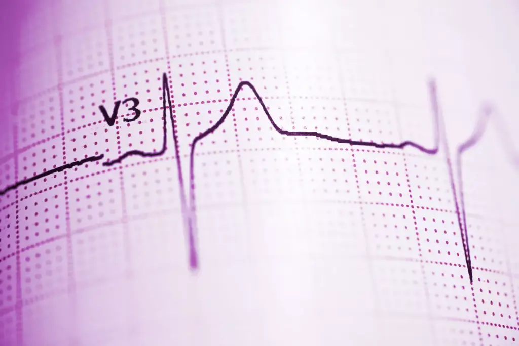 Understanding Atrial Fibrillation (AFib)