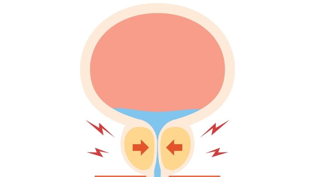 Understanding Benign Prostatic Hyperplasia