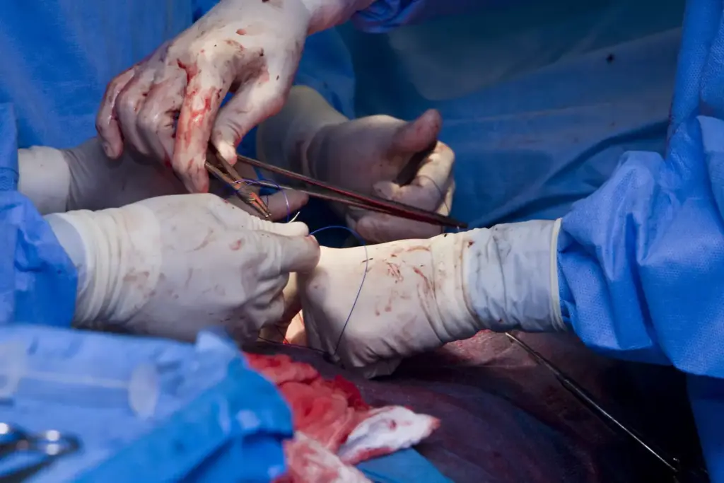 Understanding Coronary Artery Bypass Graft Surgery