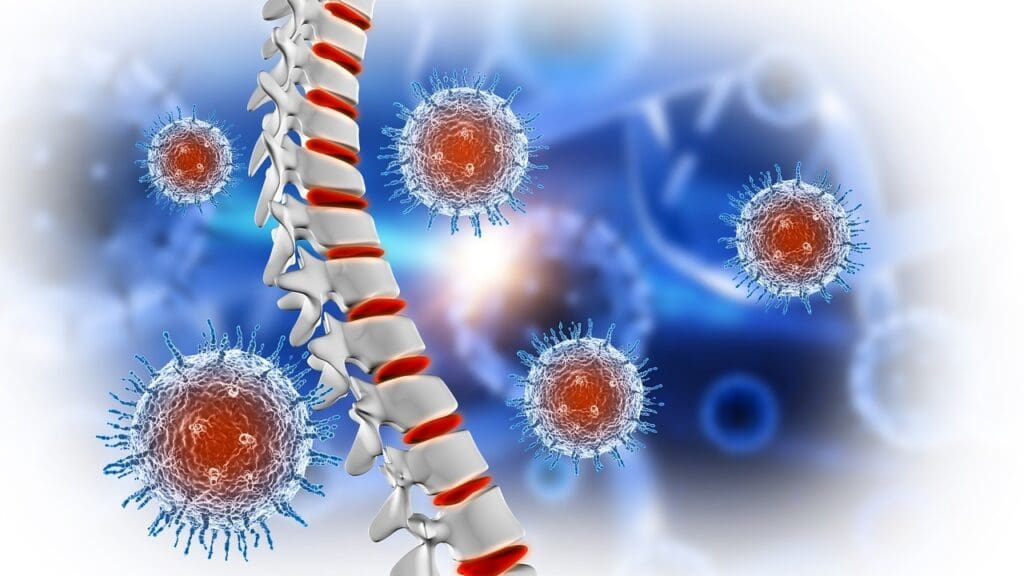 What Is Spinal Metastatic Disease