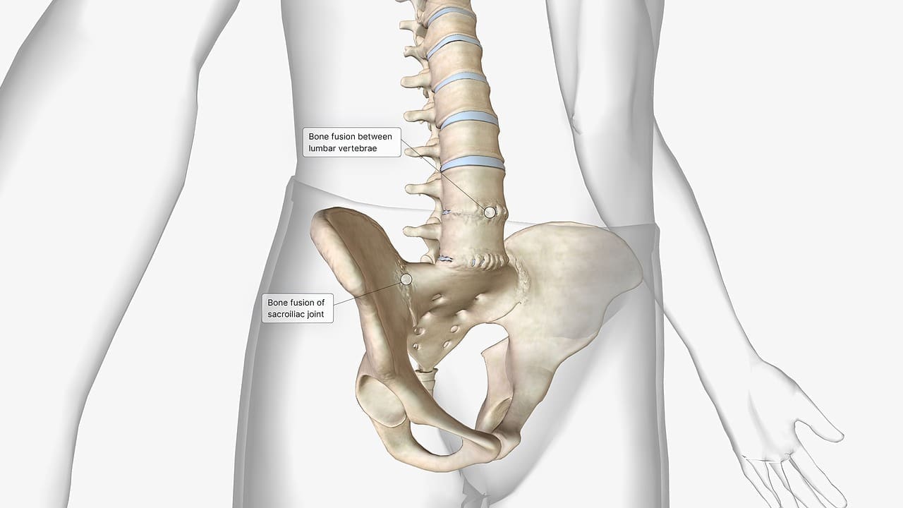 What Is a Disc Protrusion