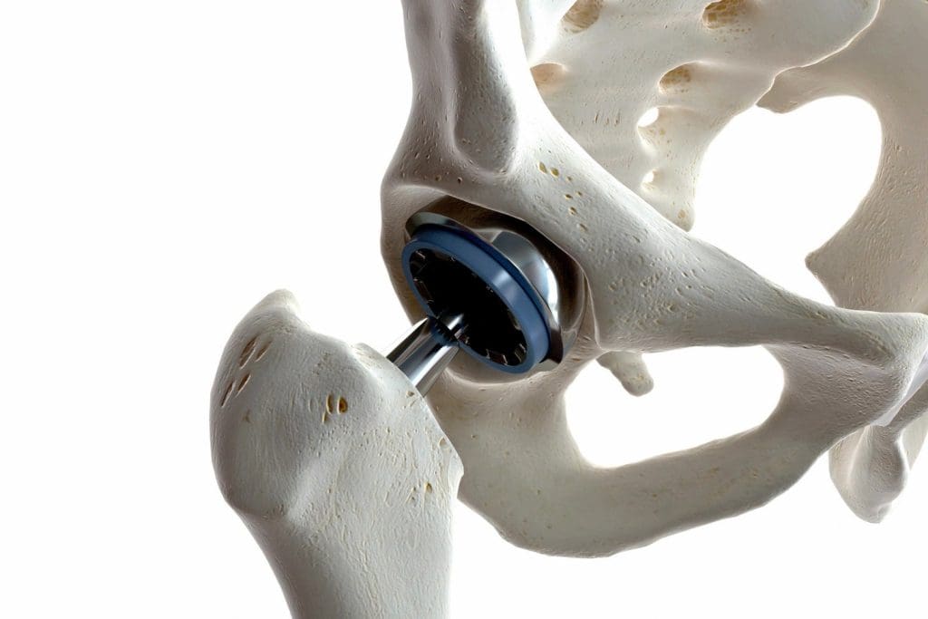 a high-quality 3D rendering of an autogenous bone graft