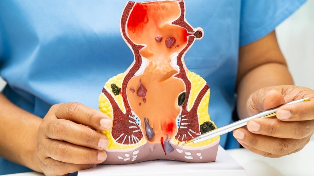 abdominal aortic aneurysm