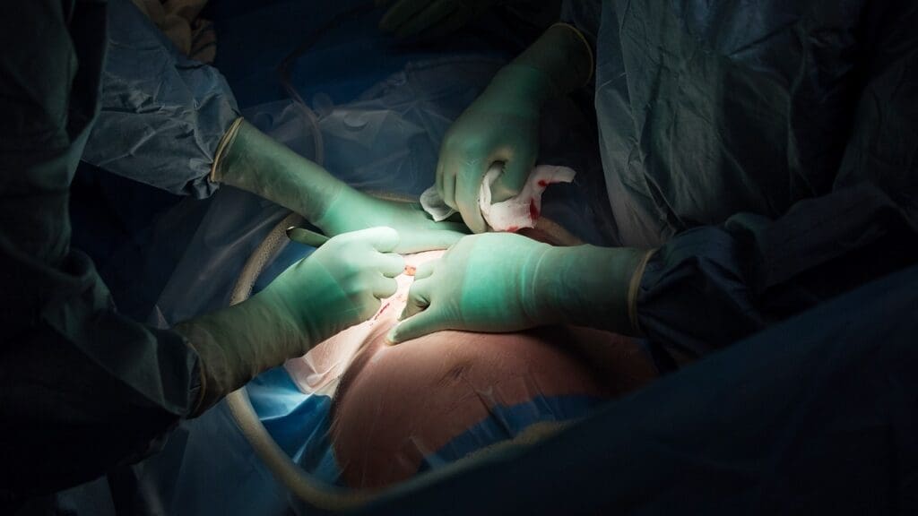 abdominal aortic aneurysm repair