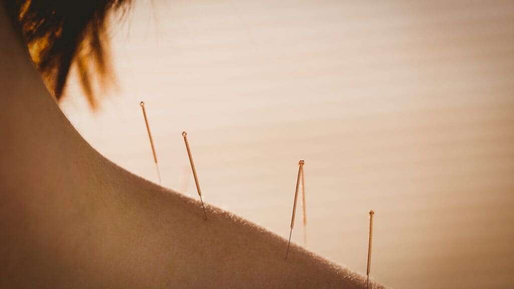 acupuncture
