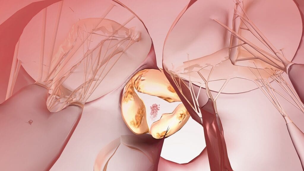 age-related heart valve calcification