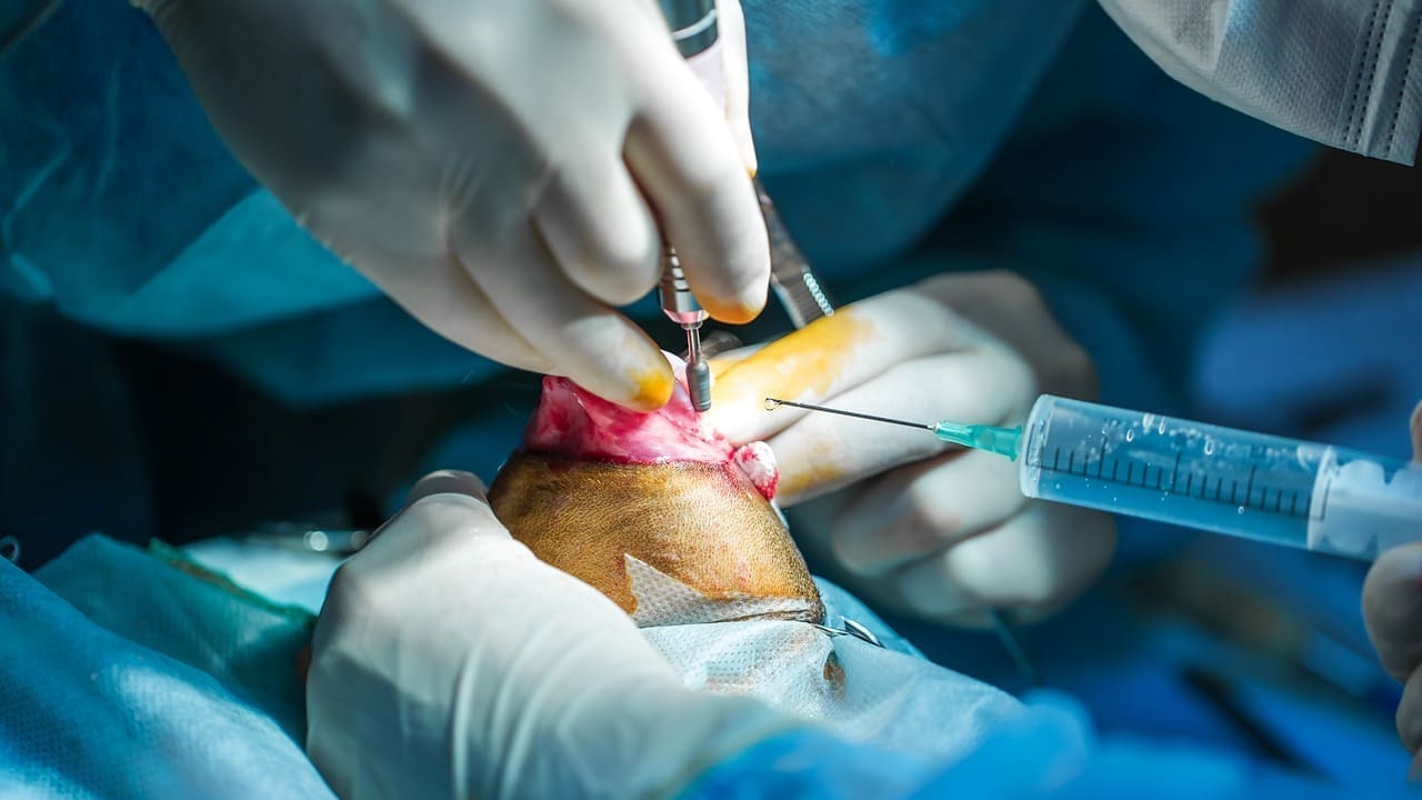 allograft bone graft