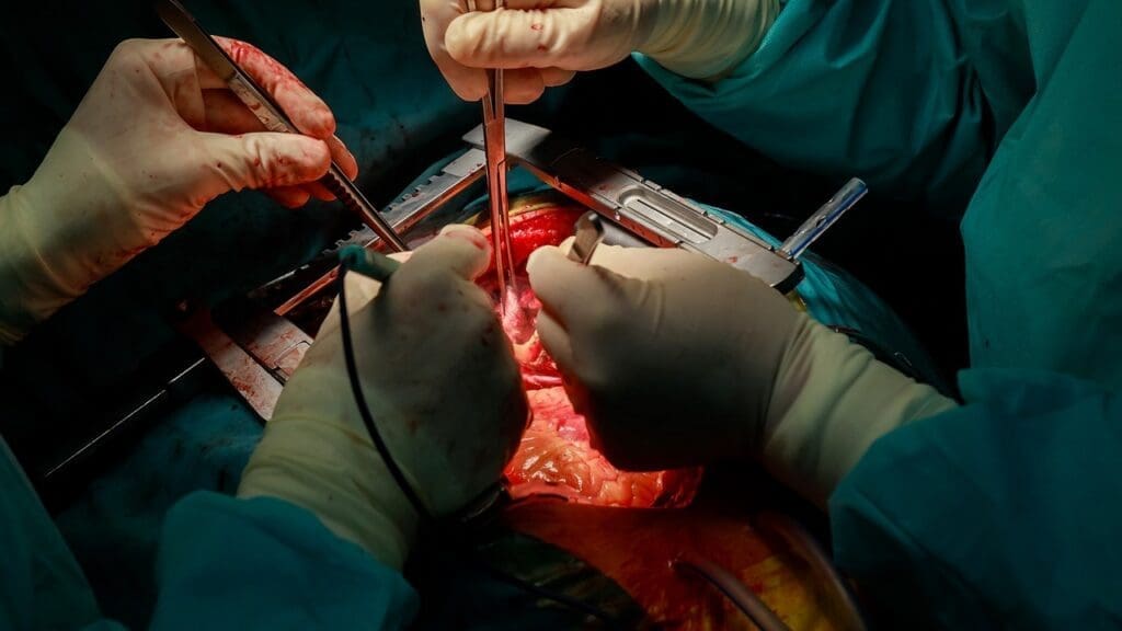 aneurysm removal