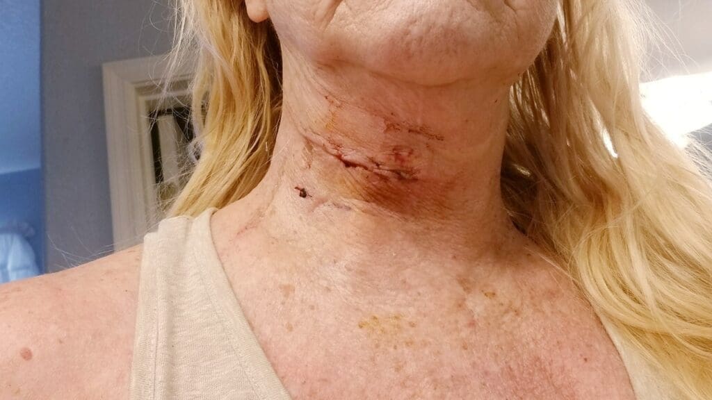 7 Essential Tips for Anterior Cervical Fusion Scar Care and Healing