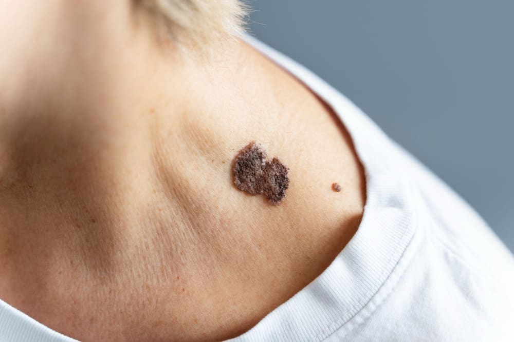 basal cell carcinoma