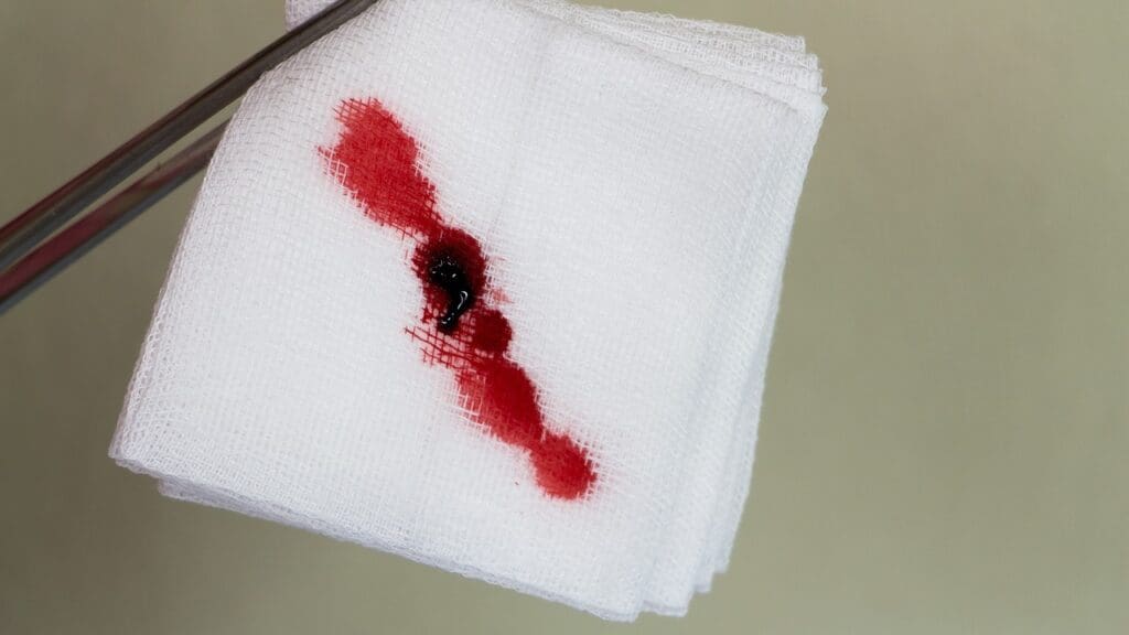 7 Common Causes of Blood in Urine Months After Prostatectomy