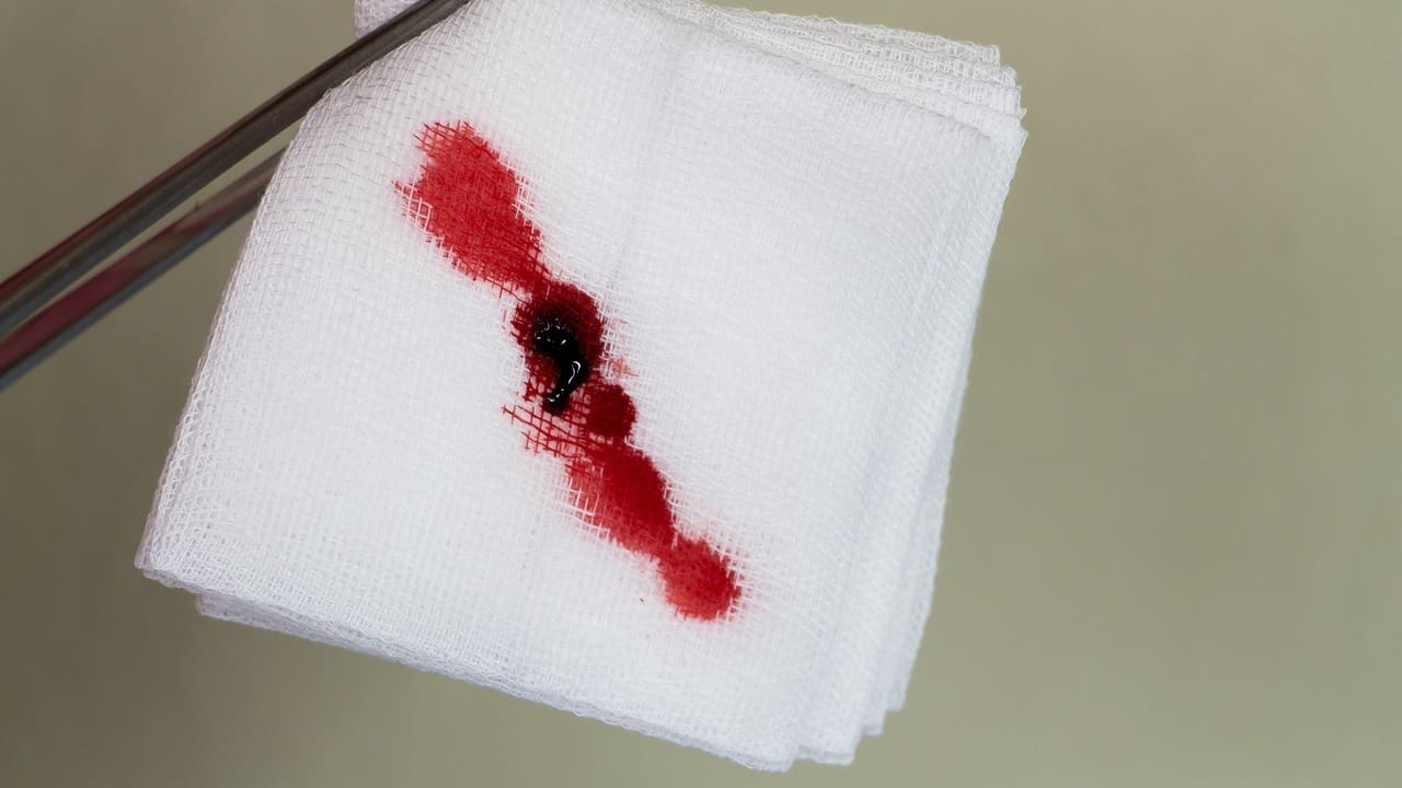 blood in urine 3 months after prostatectomy