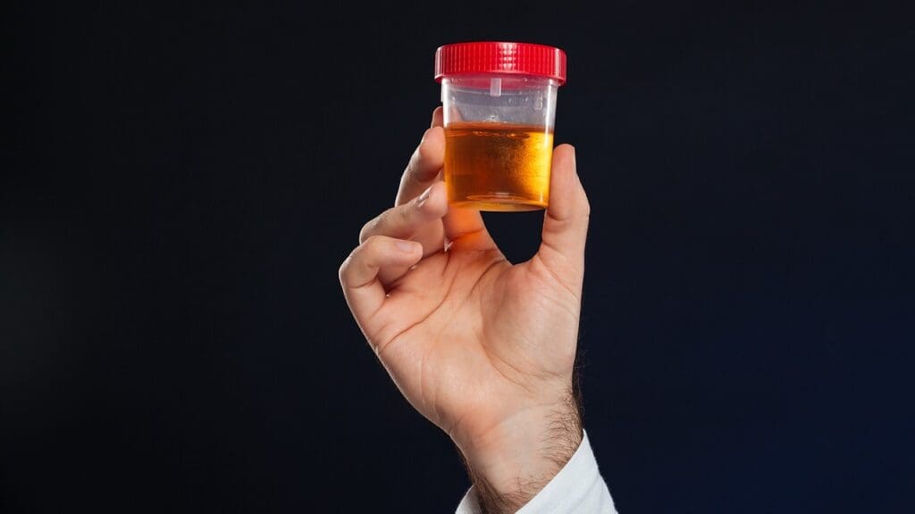 Bloody Urine After Prostatectomy: 7 Key Facts and What to Expect