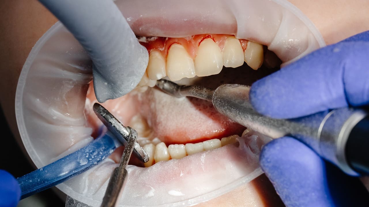 bone graft teeth