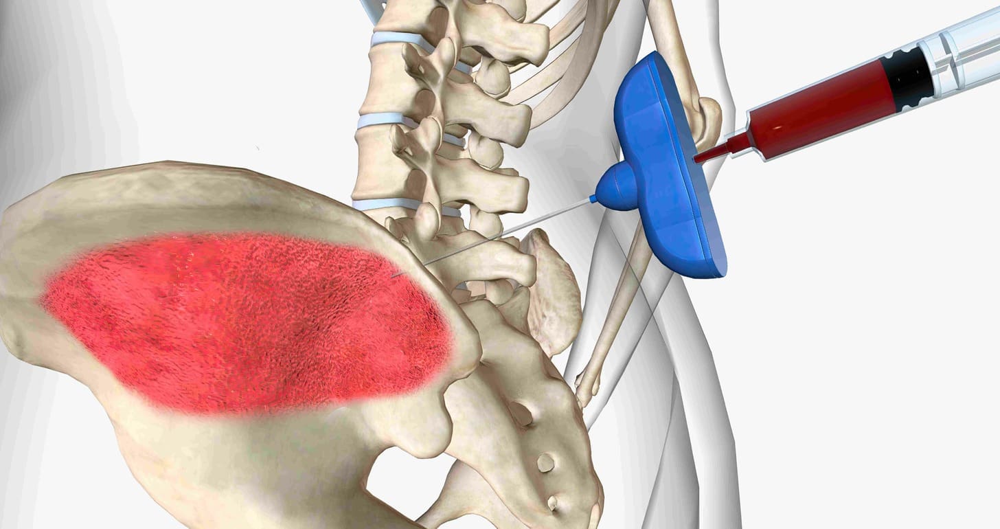 bone marrow aspiration scar