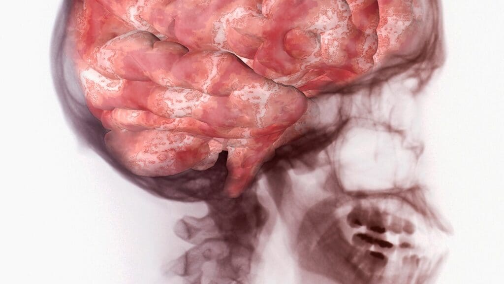 brain cancer final stage