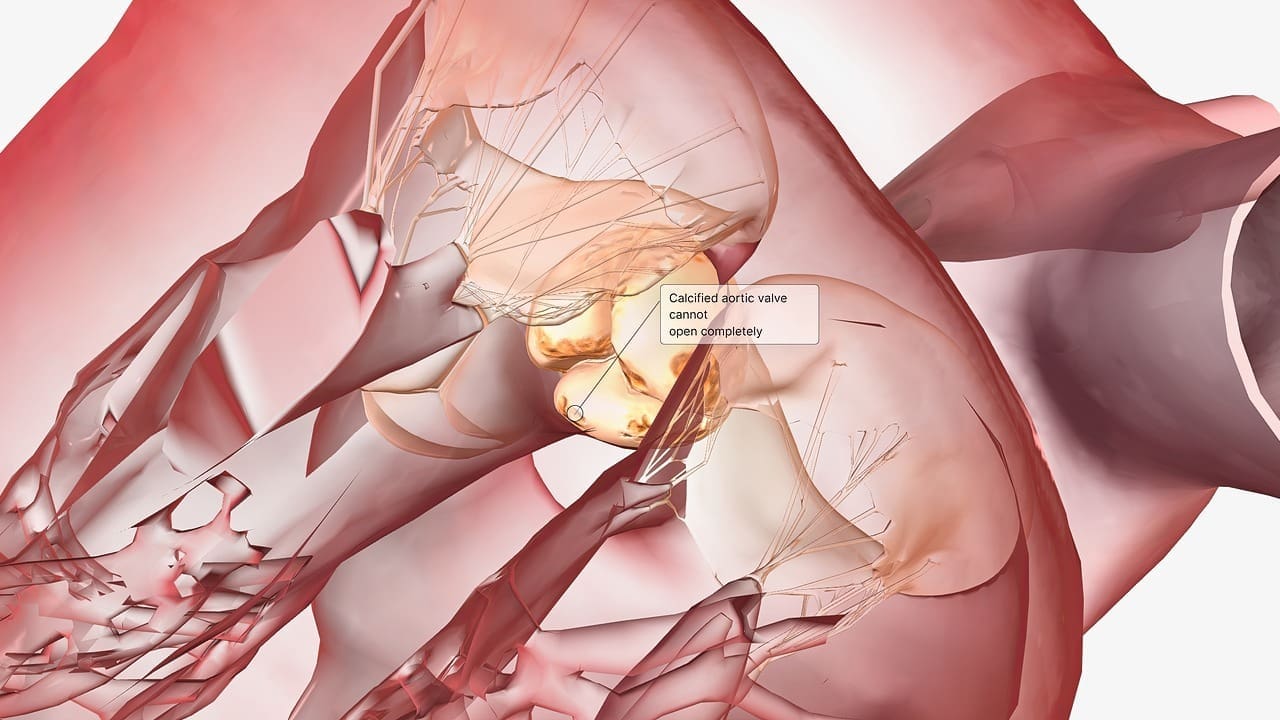 calcified heart valve