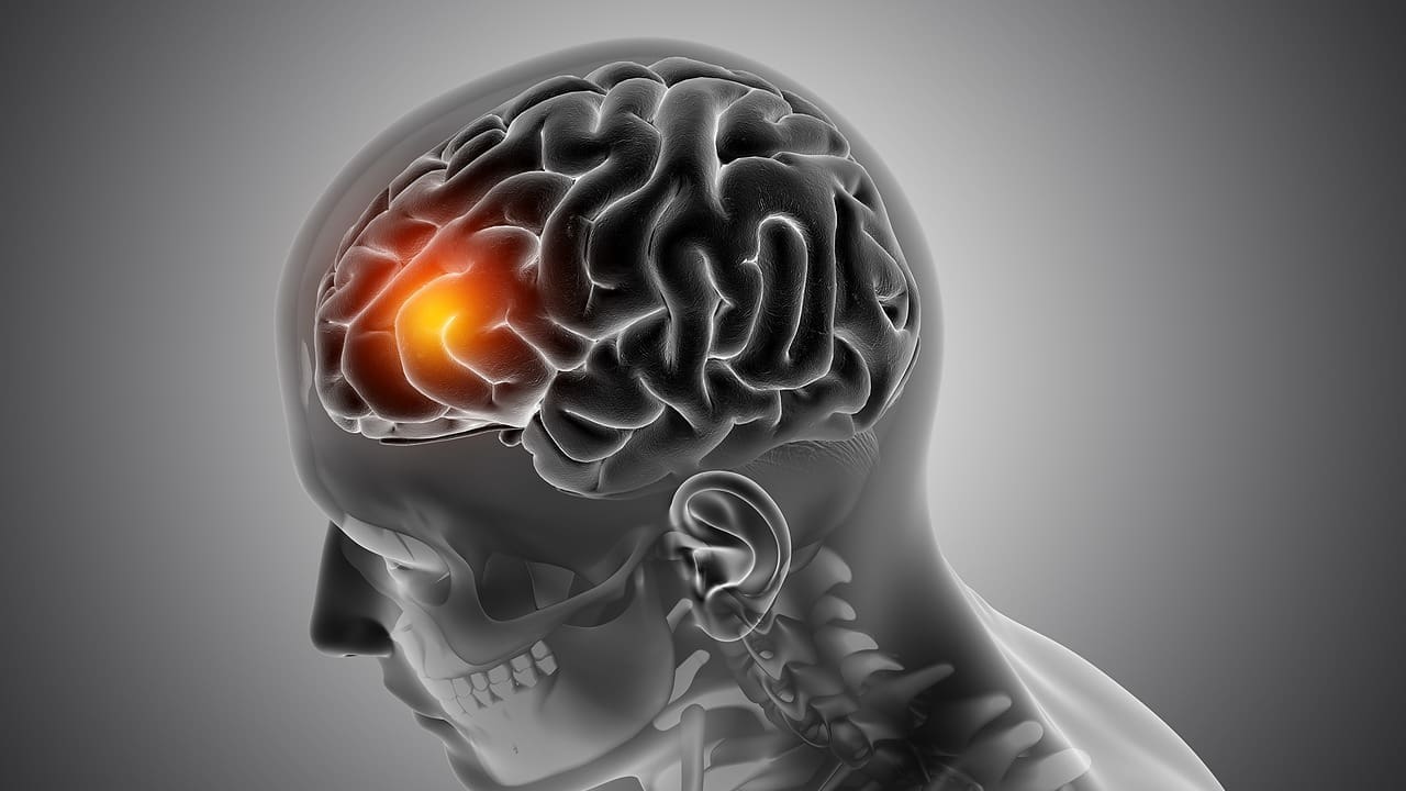 can a brain tumor cause vertigo