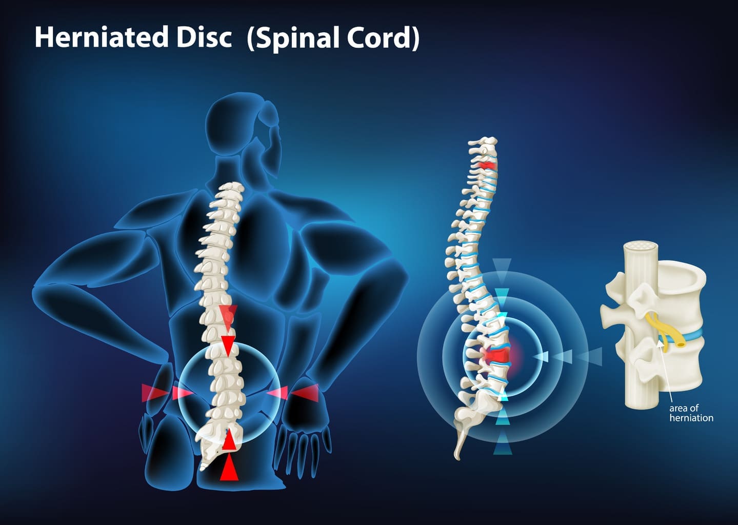 can a slipped disc cause hip pain