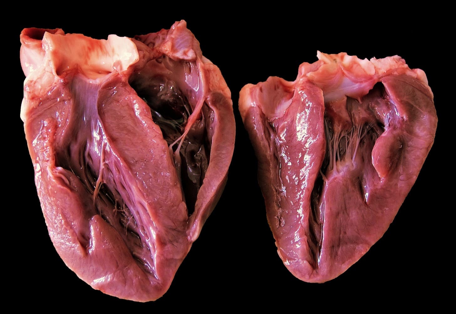 cardiac valve calcification