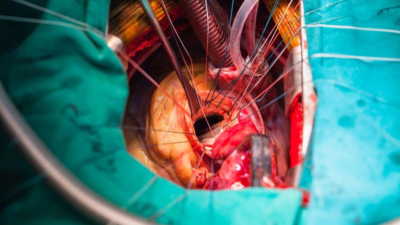 cardiac valve repair surgery