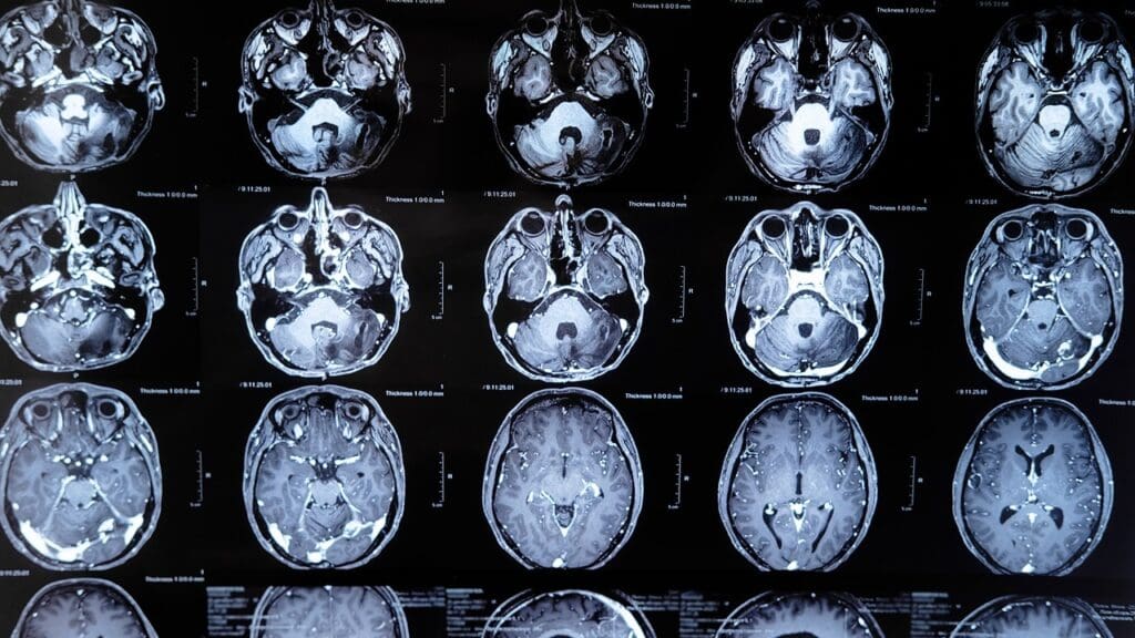 cerebral edema pathophysiology