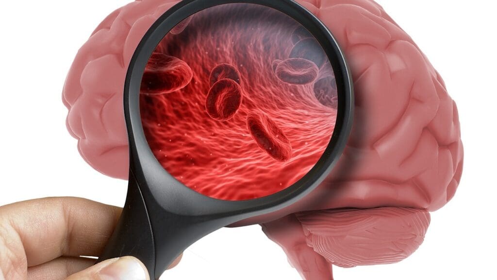 cerebral infarction definition