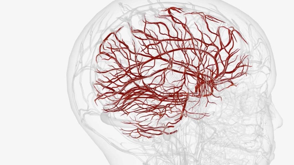 cerebral venous malformation