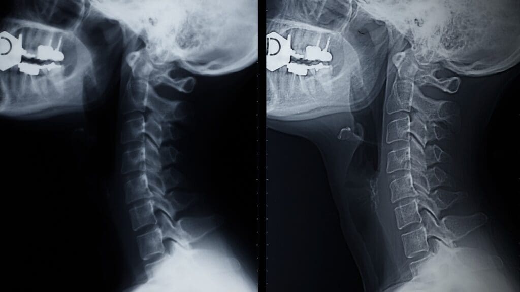 cervical acdf surgery