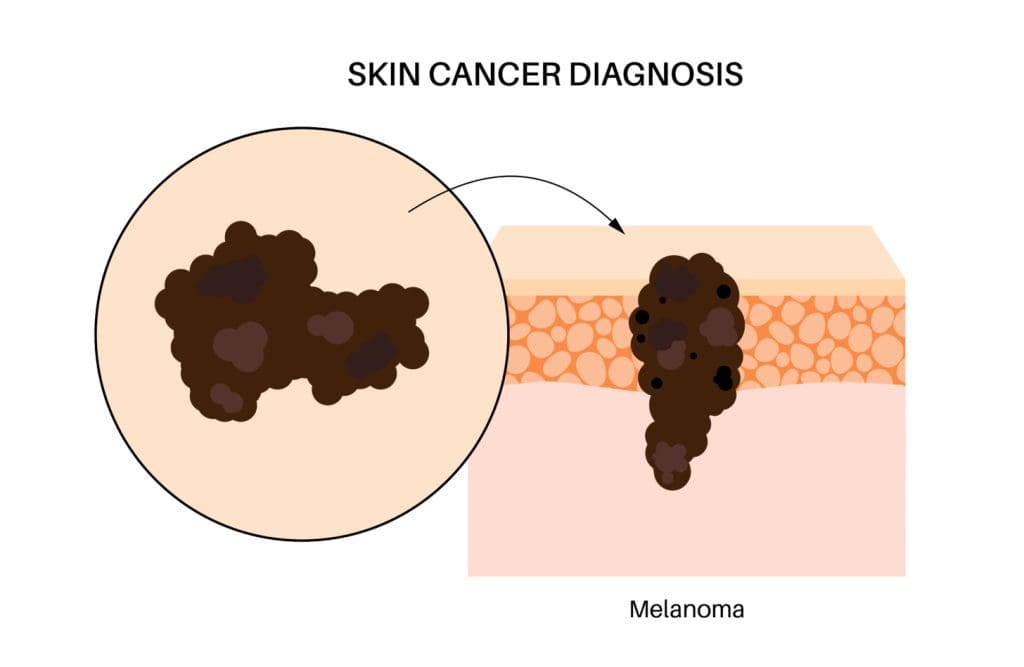 cross-section of basal cell carcinoma