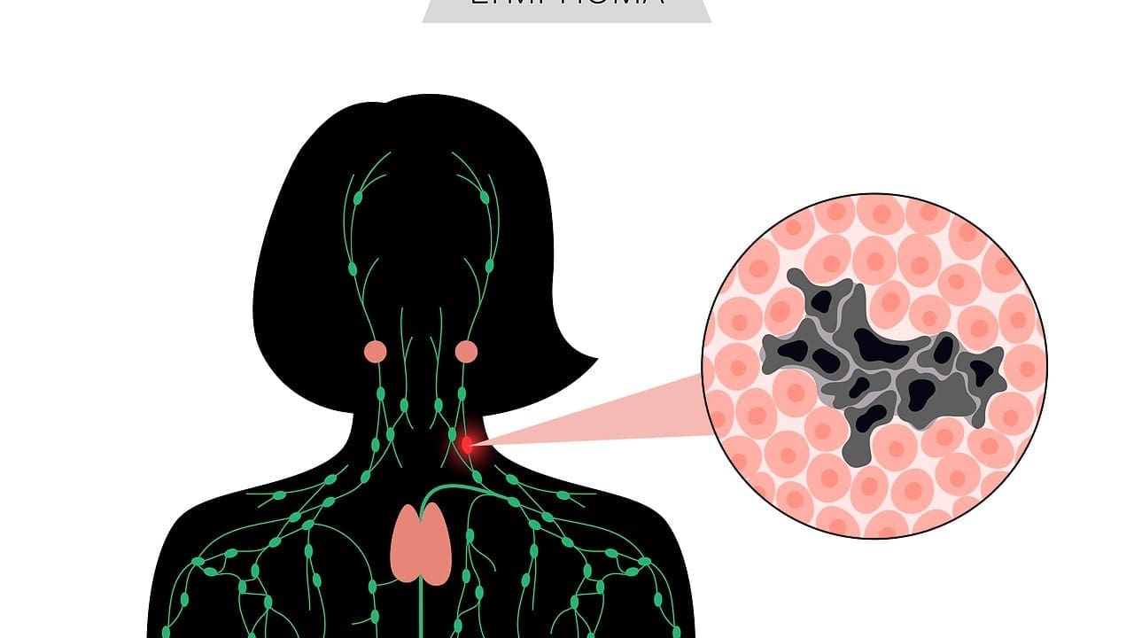 diffuse large b cell lymphoma stage 3