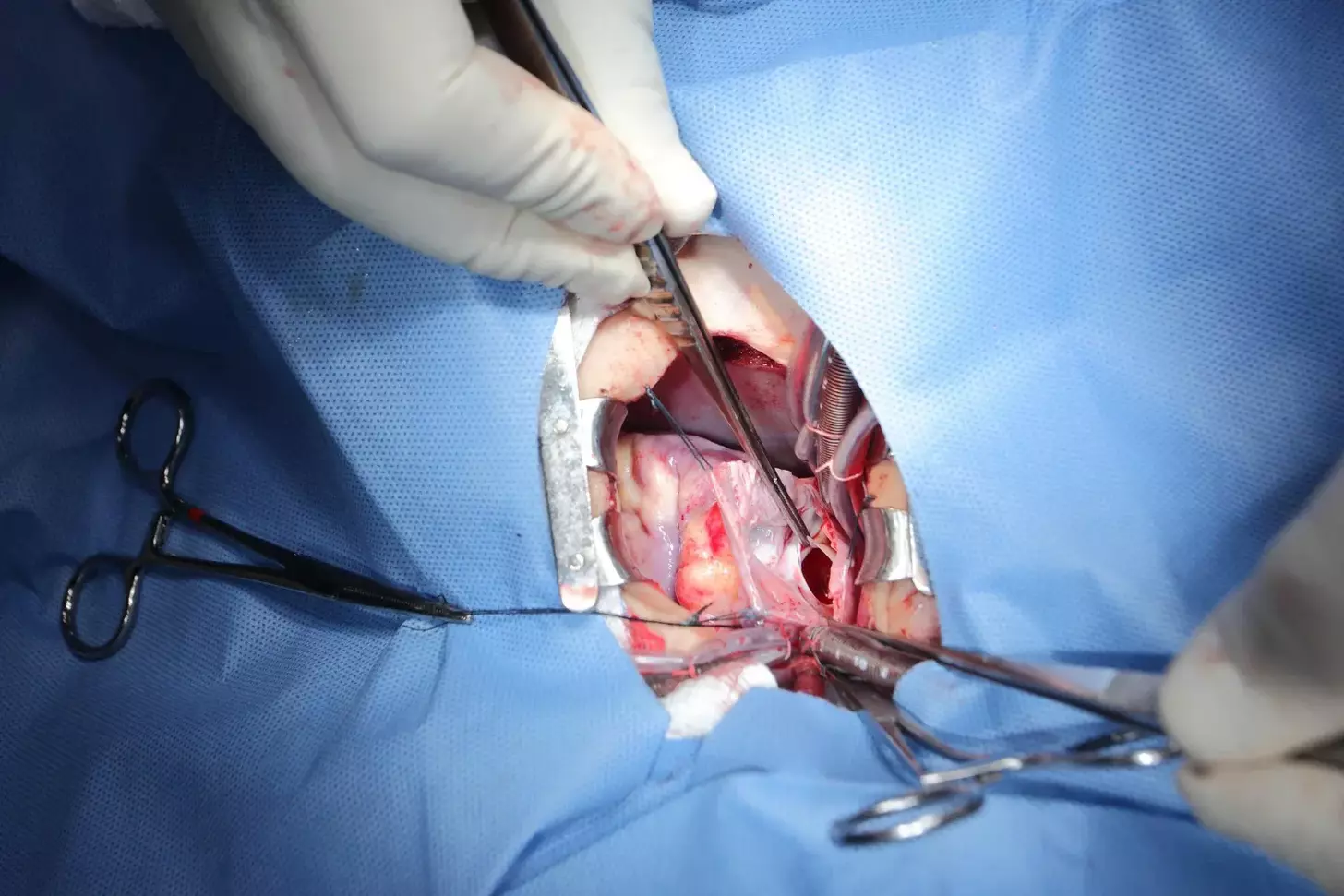 fibroids laparoscopic surgery