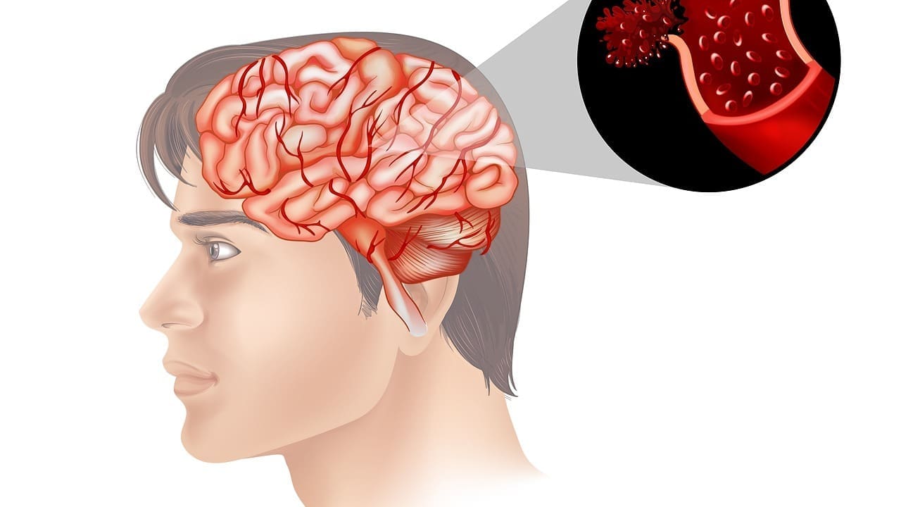 hardening of the arteries in the brain