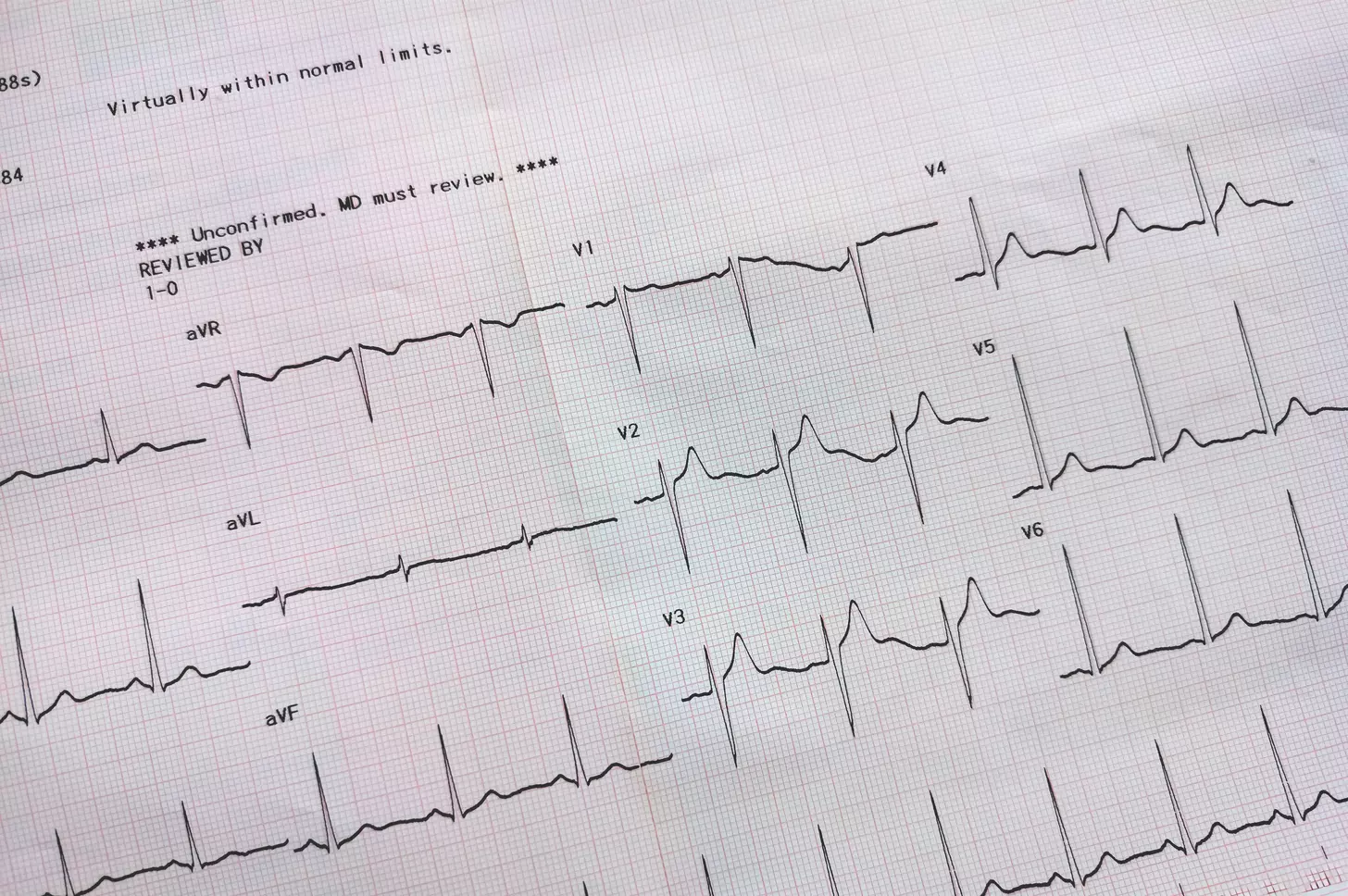 heart sinus rhythm
