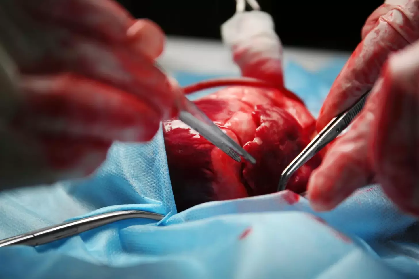 how long does a valve replacement take