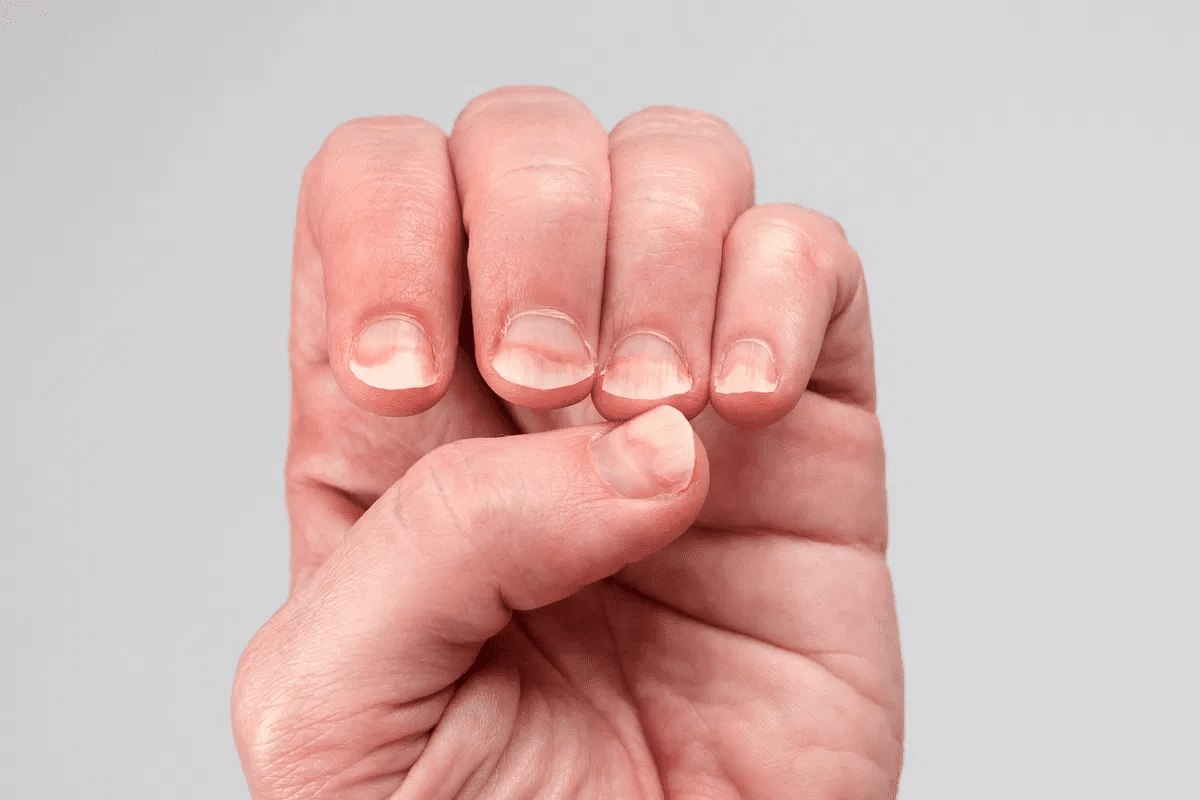 Identifying Fingernails with Psoriatic Arthritis