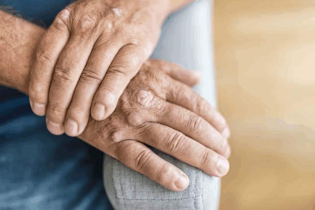 Why Proper Psoriatic Arthritis Treatment Is Crucial