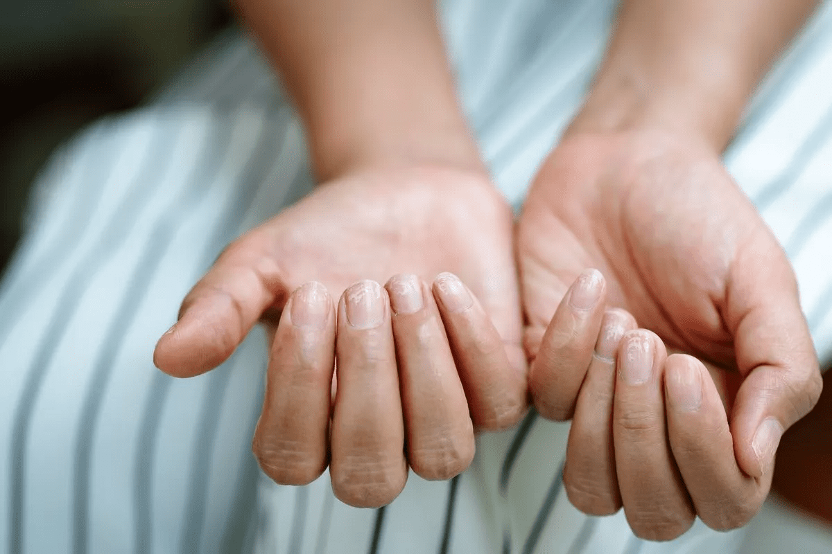 Understanding Psoriatic Arthritis Disability Benefits