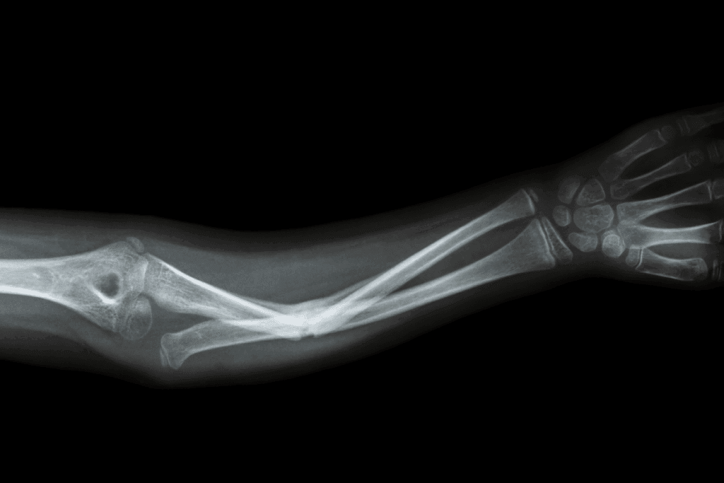 Self Healing Fractures: Is it Possible? The Shocking Answer