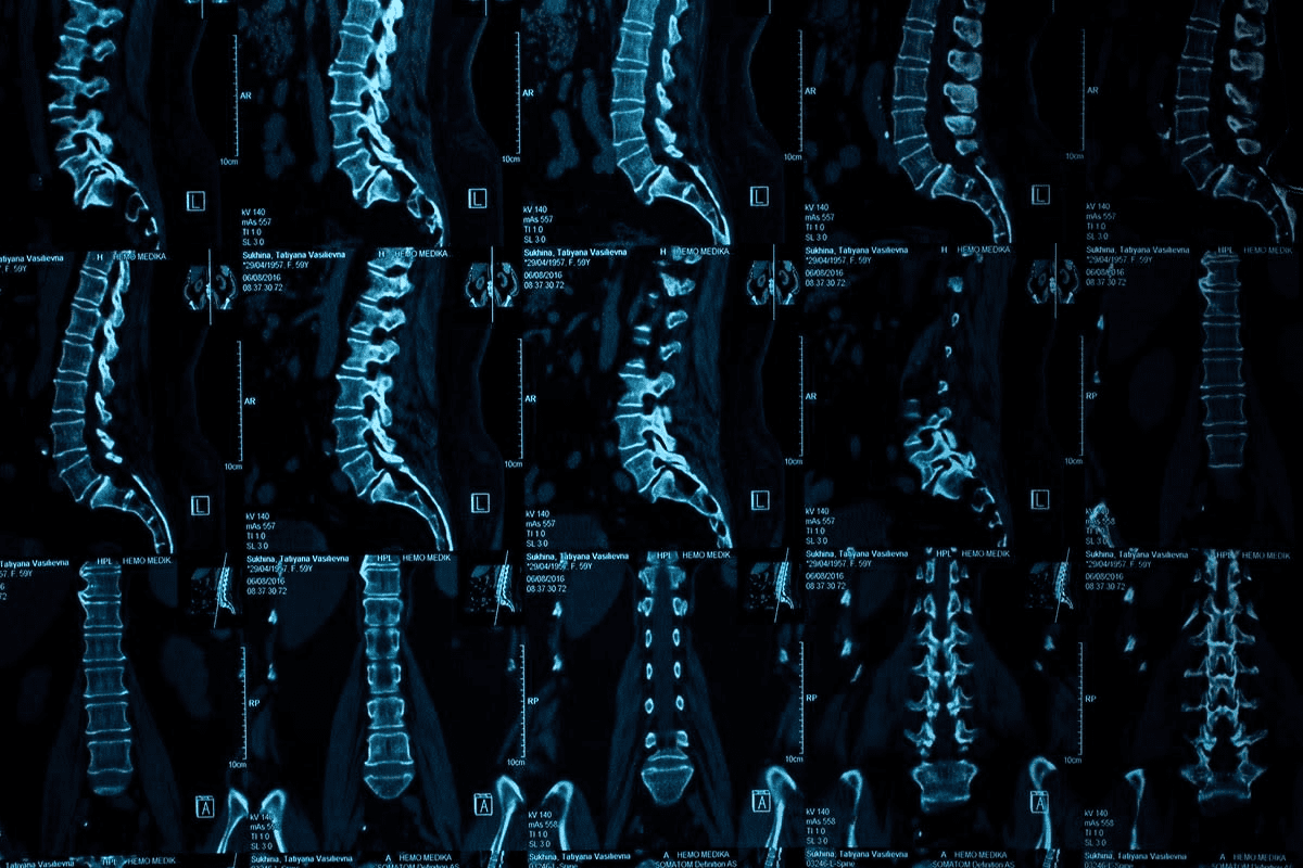 How a CT Scan Herniated Disc Detects Spine Damage