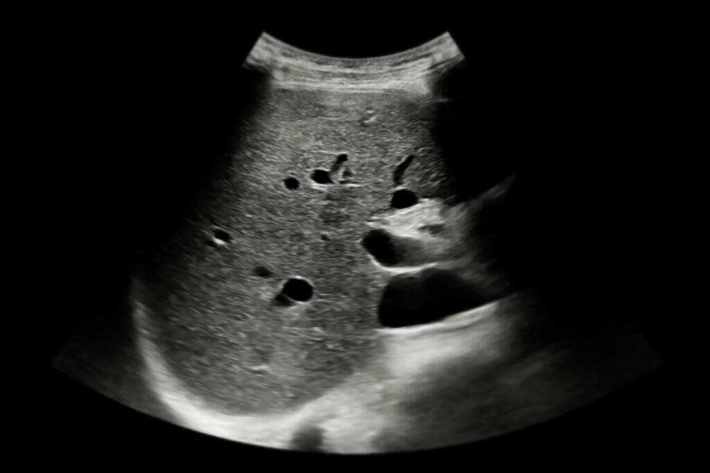 Creatinine: Ultrasound Detection of Failure