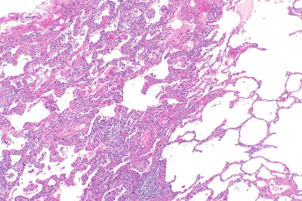 Interstitial Cystitis: Bladder Ultrasound Pain 3 Interstitial Cystitis: Bladder Ultrasound Pain