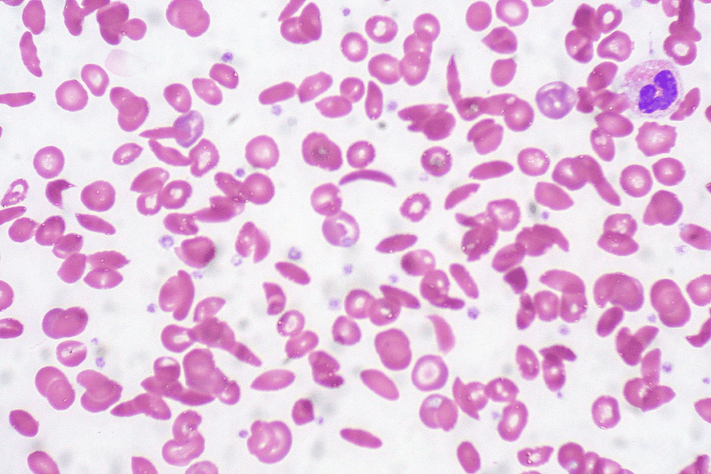 Sickle Cell Anemia Differential Diagnosis