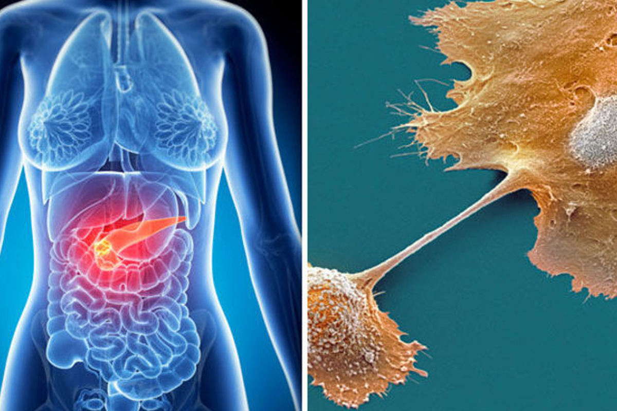 Bladder Cancer Treatment: Crucial Most Treatable Stage