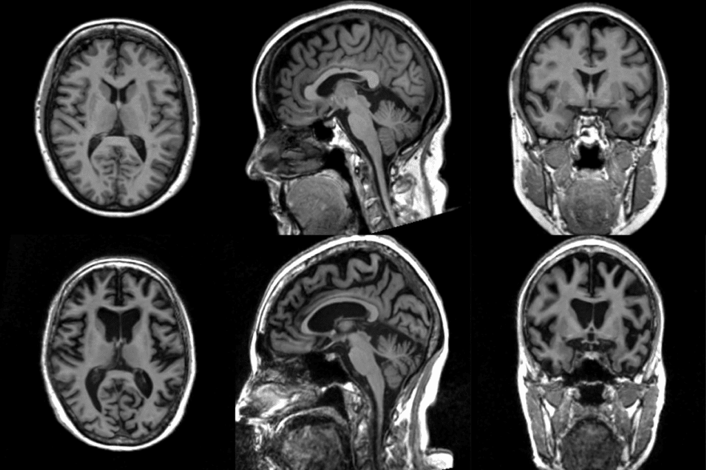 Cerebral Embolization: 7 Key Facts