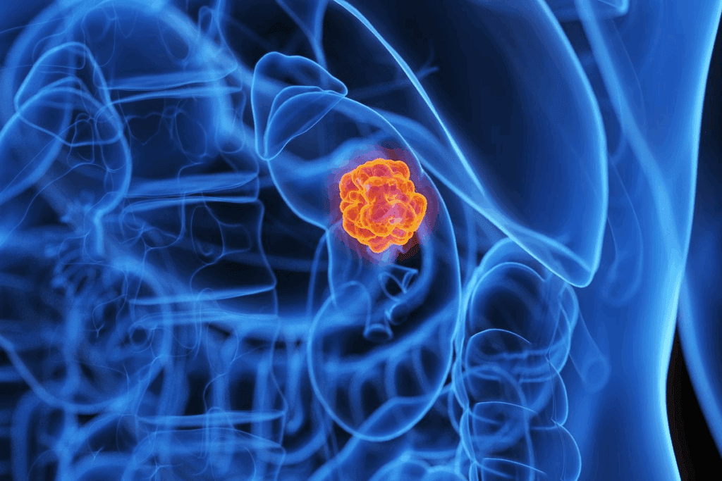 7 Essential Facts About Ablation for Kidney Cancer: Procedures, Benefits, and Risks | Ablation Kidney Cancer 1 7 Essential Facts About Ablation for Kidney Cancer: Procedures, Benefits, and Risks | Ablation Kidney Cancer