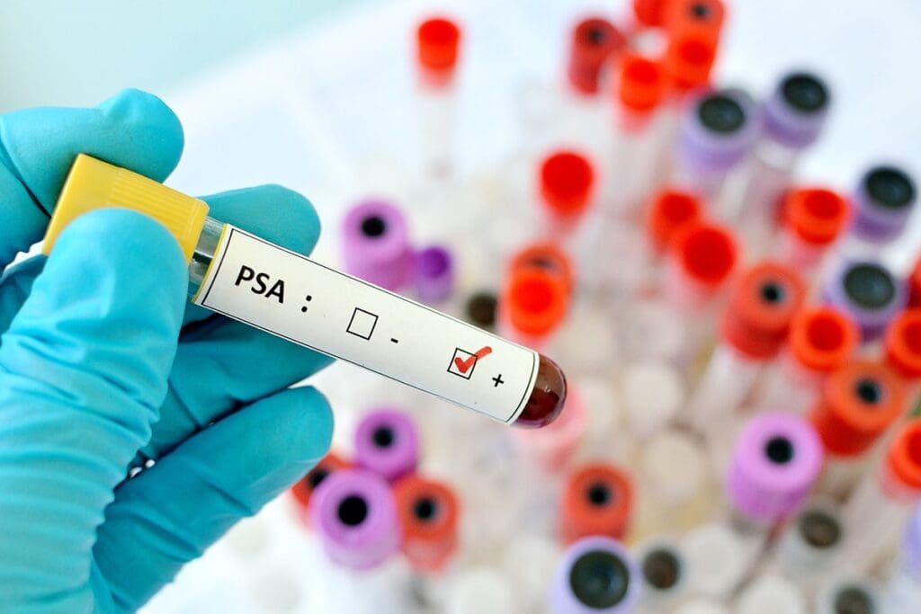 Blood Test Prostate PSA: 5 Key Facts You Should Know for Better Health 2 Blood Test Prostate PSA: 5 Key Facts You Should Know for Better Health